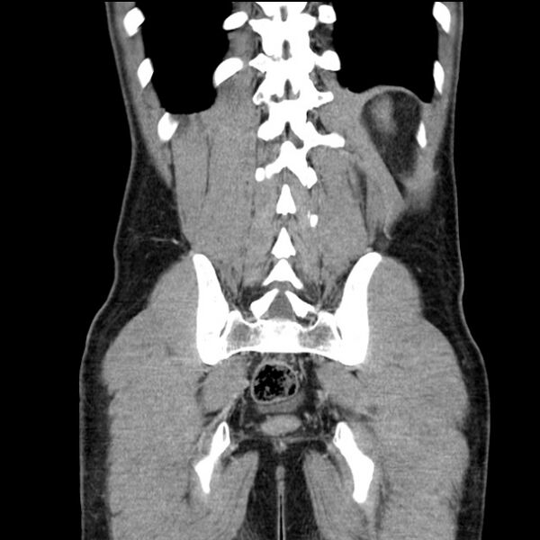 File:Acute appendicitis (Radiopaedia 27049-27227 Coronal C+ portal venous phase 47).jpg