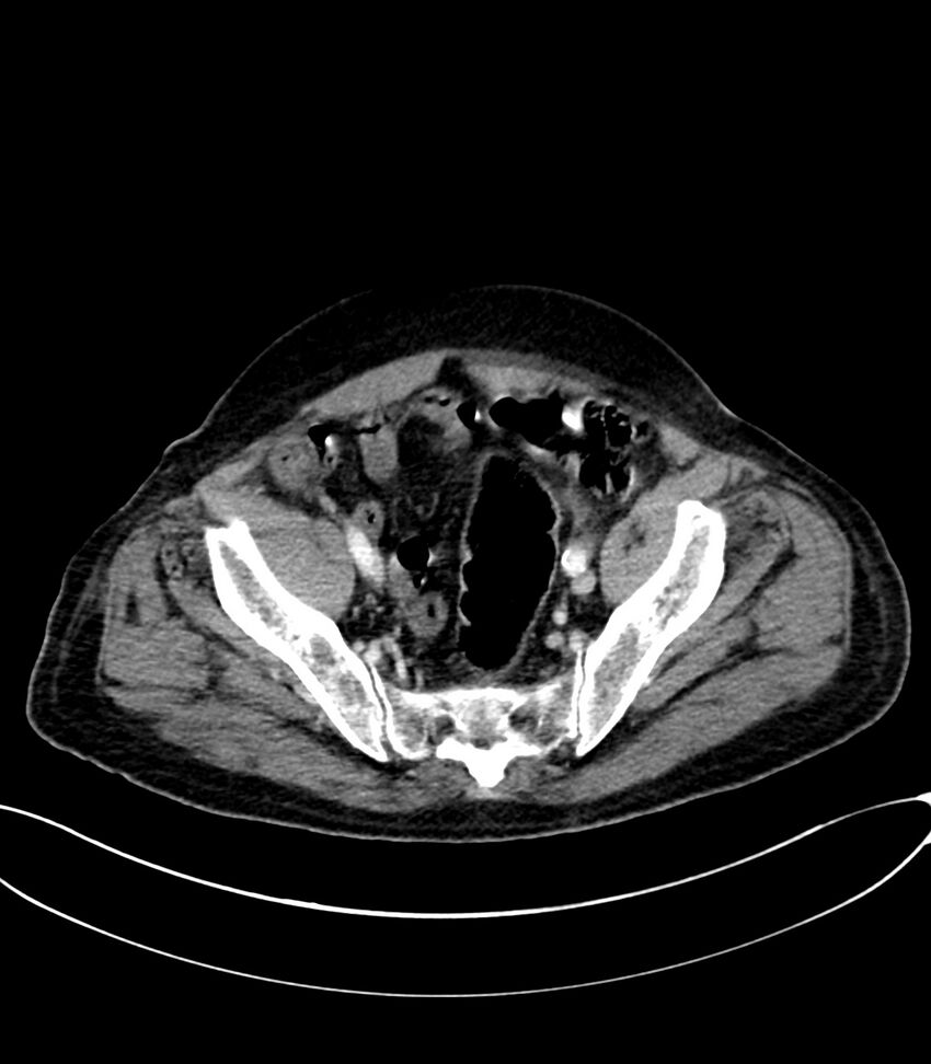 Acute arterial mesenteric ischemia (Radiopaedia 78238-90828 Axial C+ portal venous phase 118).jpg