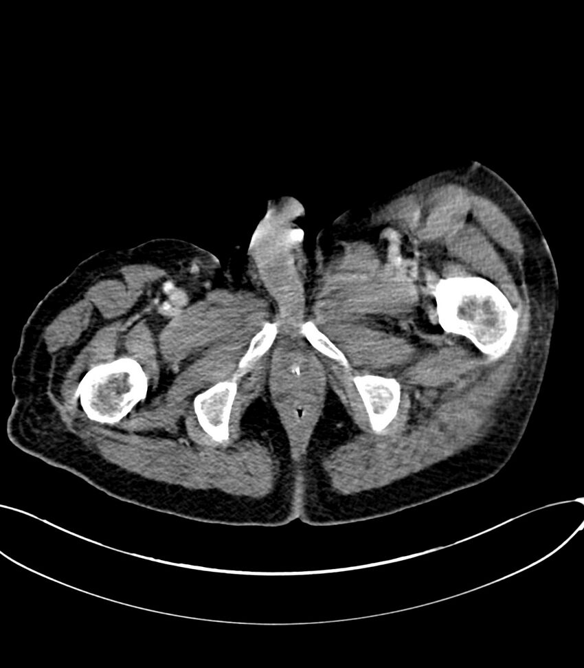 Acute arterial mesenteric ischemia (Radiopaedia 78238-90828 Axial C+ portal venous phase 151).jpg