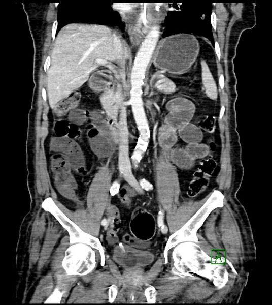 File:Acute arterial mesenteric ischemia (Radiopaedia 78238-90828 Coronal C+ portal venous phase 52).jpg
