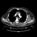 Acute heart failure (CT) (Radiopaedia 79835-93075 Axial C+ arterial phase 1).jpg