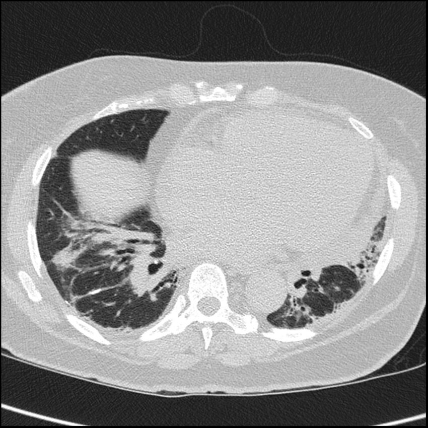 Acute interstitial pneumonitis (Radiopaedia 45404-49453 Axial lung window 54).jpg