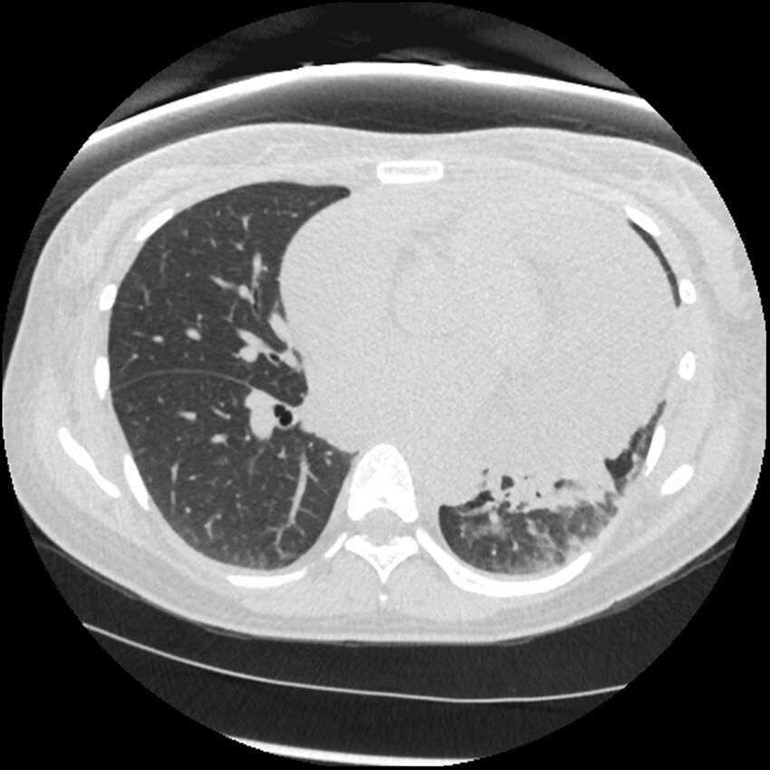 Acute lupus nephritis (Radiopaedia 45832-50107 Axial lung window 52).jpg