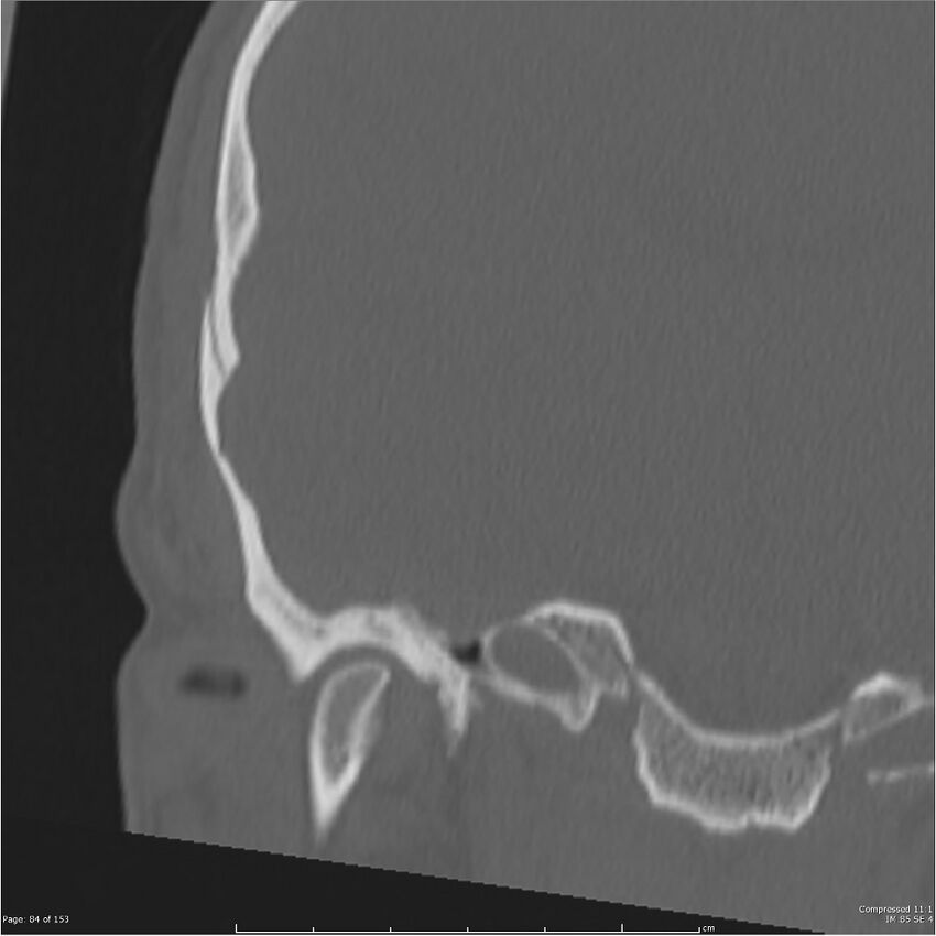 Acute otomastoiditis (Radiopaedia 28276-28512 Coronal PTB bone window reformat 15).jpg
