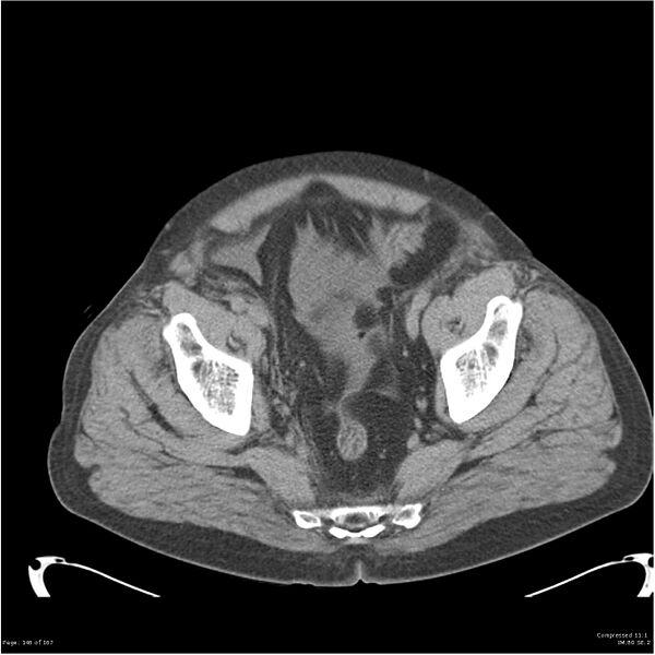 File:Acute pancreatitis (Radiopaedia 19135-19116 Axial non-contrast 52).jpg