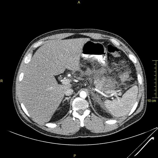File:Acute pancreatitis (Radiopaedia 23231-23290 Axial C+ arterial phase 13).JPG