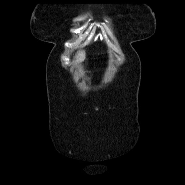 File:Acute pancreatitis - Balthazar C (Radiopaedia 26569-26714 Coronal C+ portal venous phase 12).jpg