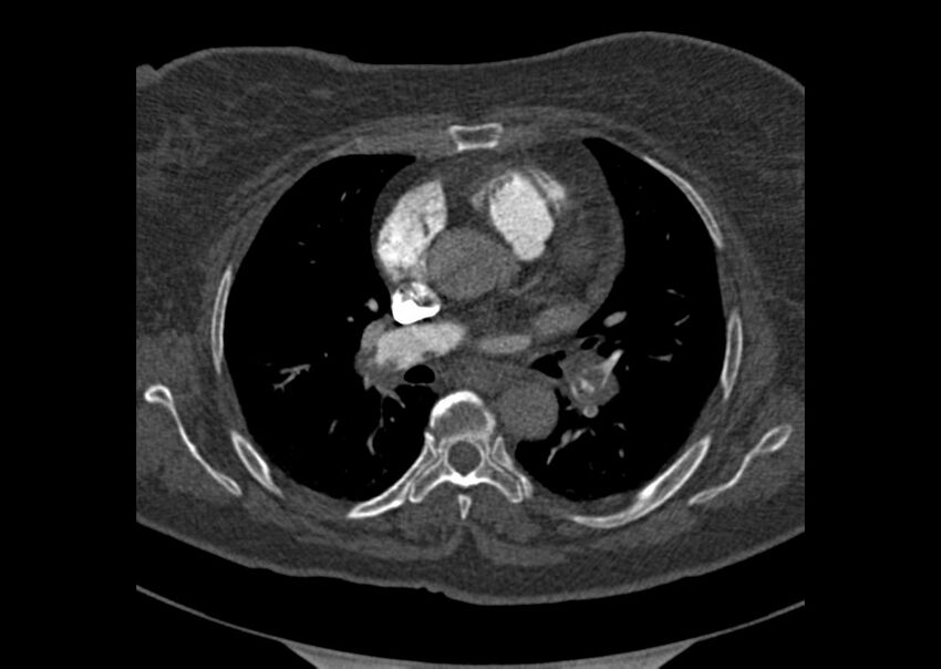 Acute pulmonary embolism (Radiopaedia 29938-30466 Axial C+ CTPA 74).jpg