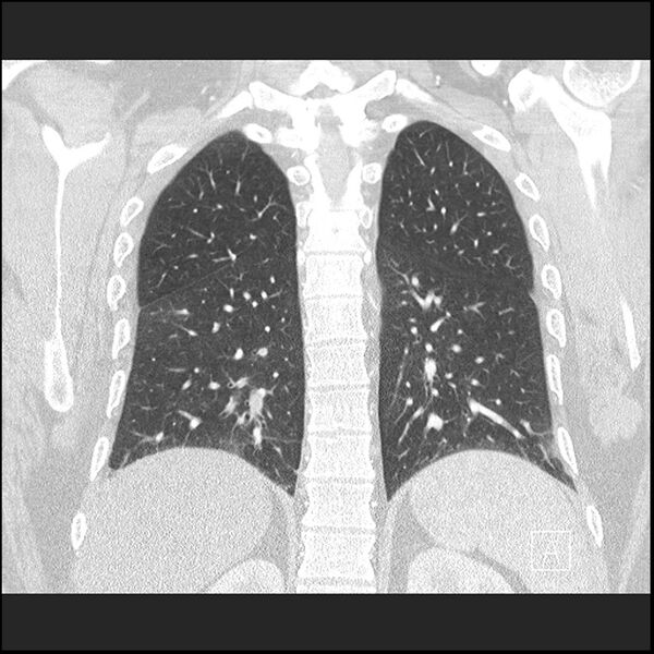 File:Acute pulmonary embolism with pulmonary infarct (Radiopaedia 73062-83768 Coronal lung window 55).jpg