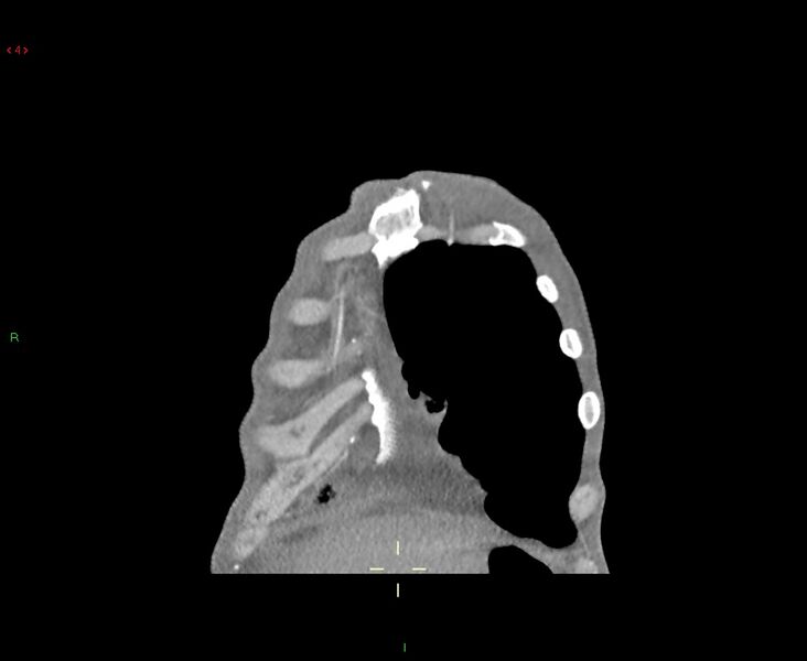 File:Acute right lung abscess (Radiopaedia 34806-36258 Coronal C+ arterial phase 52).jpg