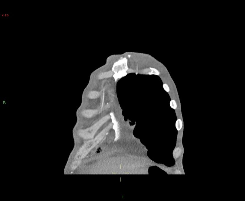 Acute right lung abscess (Radiopaedia 34806-36258 Coronal C+ arterial phase 52).jpg