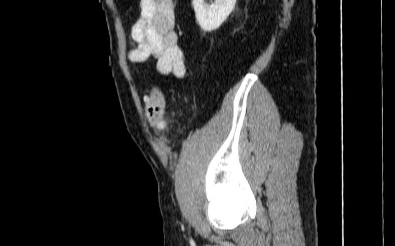 File:Acute sigmoid colon diverticulitis (Radiopaedia 55507-61976 Sagittal C+ portal venous phase 104).jpg
