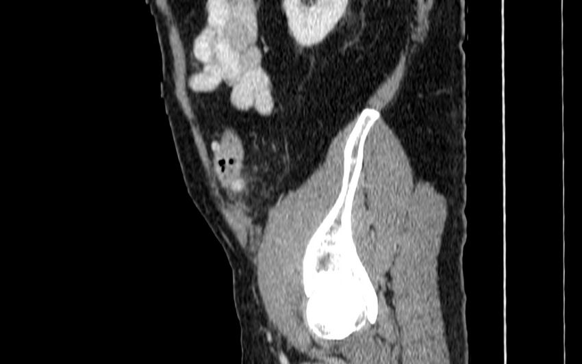 Acute sigmoid colon diverticulitis (Radiopaedia 55507-61976 Sagittal C+ portal venous phase 104).jpg