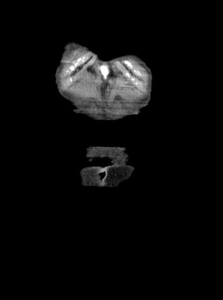 File:Acute small bowel (ileal) volvulus (Radiopaedia 71740-82139 Coronal C+ portal venous phase 6).jpg