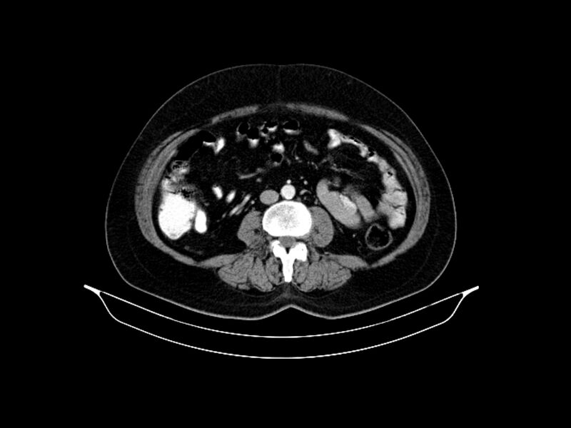 File:Adenocarcinoma of pancreas with hepatic metastasis (Radiopaedia 64332-73122 Axial C+ portal venous phase 59).jpg