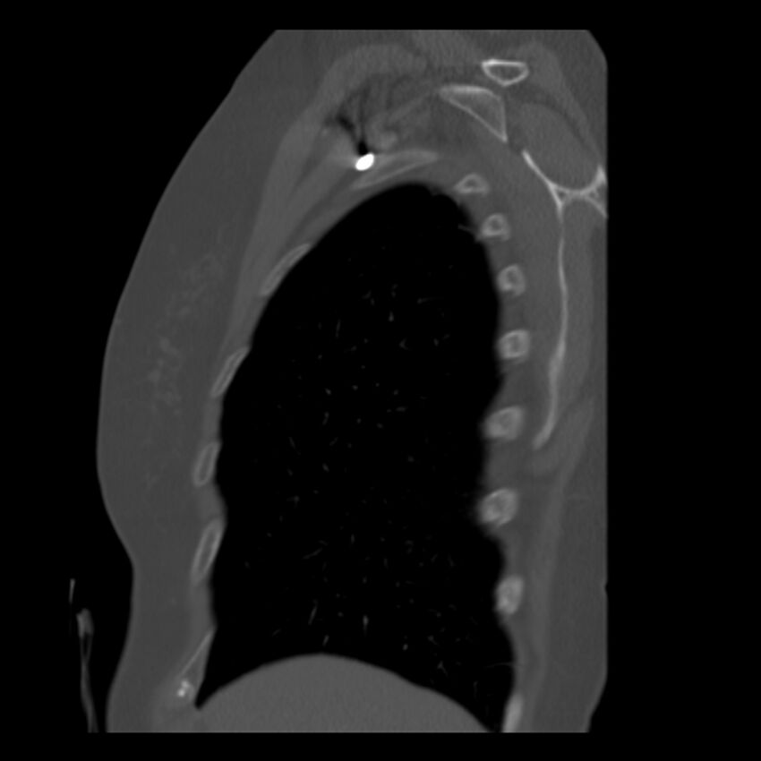 Adenocarcinoma of the lung (Radiopaedia 41015-43755 Sagittal bone window 10).jpg