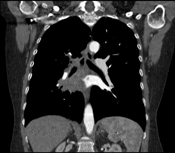 File:Adenocarcinoma of the lung (Radiopaedia 44205-47803 Coronal C+ portal venous phase 54).jpg