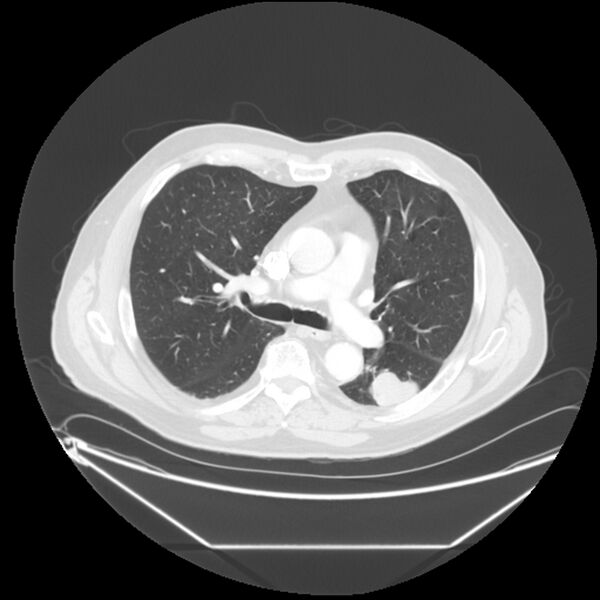 File:Adenocarcinoma of the lung (Radiopaedia 44876-48759 Axial lung window 34).jpg