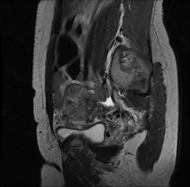 File:Adenomyosis on MRI (Radiopaedia 29328-29780 Sagittal T2 15).jpg