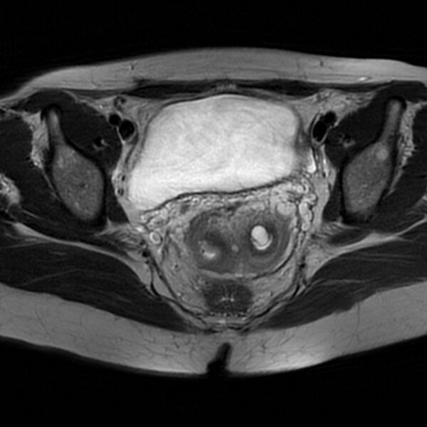 File:Adenomyosis within a septate uterus (Radiopaedia 69963-79981 Axial T2 21).jpg