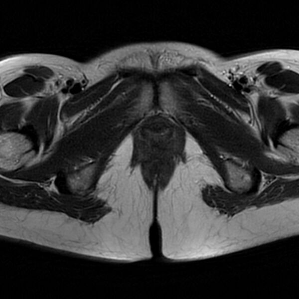 File:Adenomyosis within a septate uterus (Radiopaedia 69963-79981 Axial T2 31).jpg