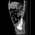 Adrenal myelolipoma (Radiopaedia 41843-44834 Sagittal non-contrast 11).jpg