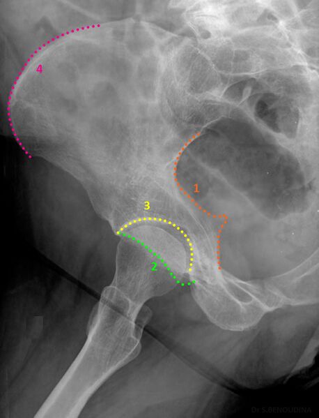 File:Adult normal pelvis- annotated iliac oblique view (Radiopaedia 46752).jpg