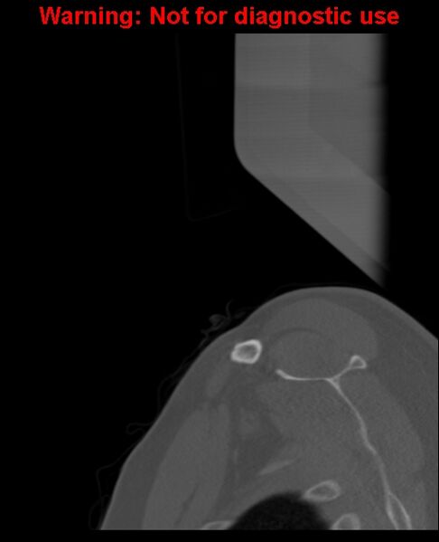 File:Ameloblastoma (Radiopaedia 33126-34164 Sagittal bone window 2).jpg