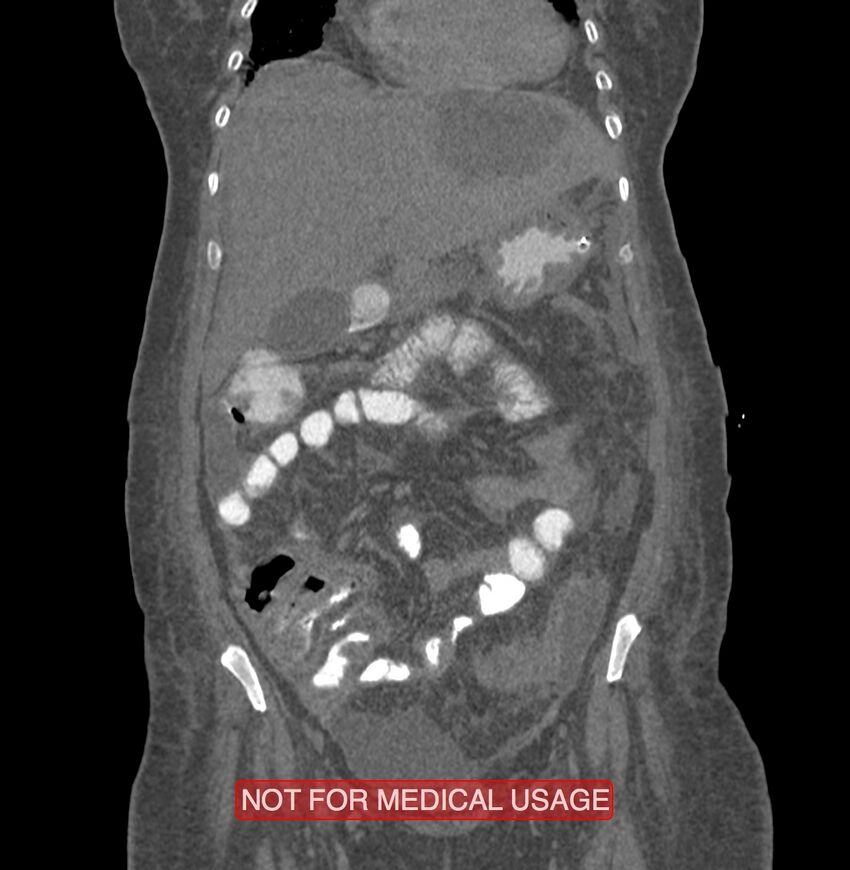 Amoebic enterocolitis with liver abscess (Radiopaedia 35100-36609 B 55).jpg