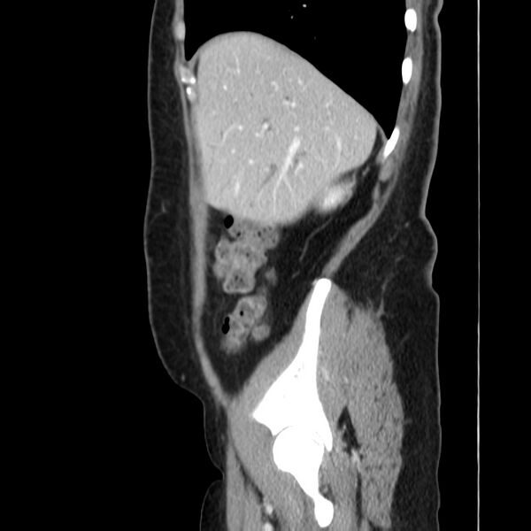 File:Ampullary tumor (Radiopaedia 22787-22816 D 12).jpg