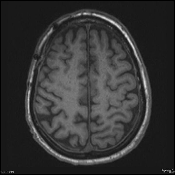 File:Anaplastic meningioma with recurrence (Radiopaedia 34452-35788 Axial T1 108).jpg