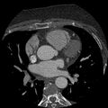 Anomalous origin of left circumflex artery from right coronary sinus (Radiopaedia 72563-83117 B 45).jpg