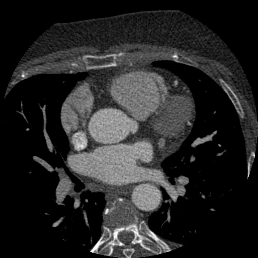 Anomalous origin of left circumflex artery from right coronary sinus (Radiopaedia 72563-83117 B 45).jpg