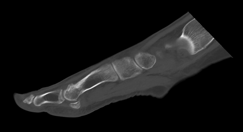 File:Anterior calcaneal process fracture (Radiopaedia 47384-51989 Sagittal bone window 24).png
