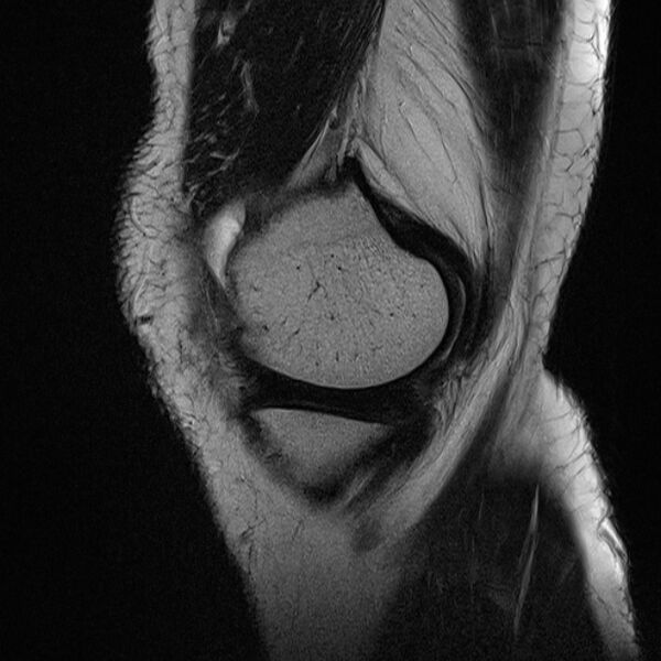 File:Anterior cruciate ligament tear - ramp lesion (Radiopaedia 71883-82322 Sagittal T2 21).jpg