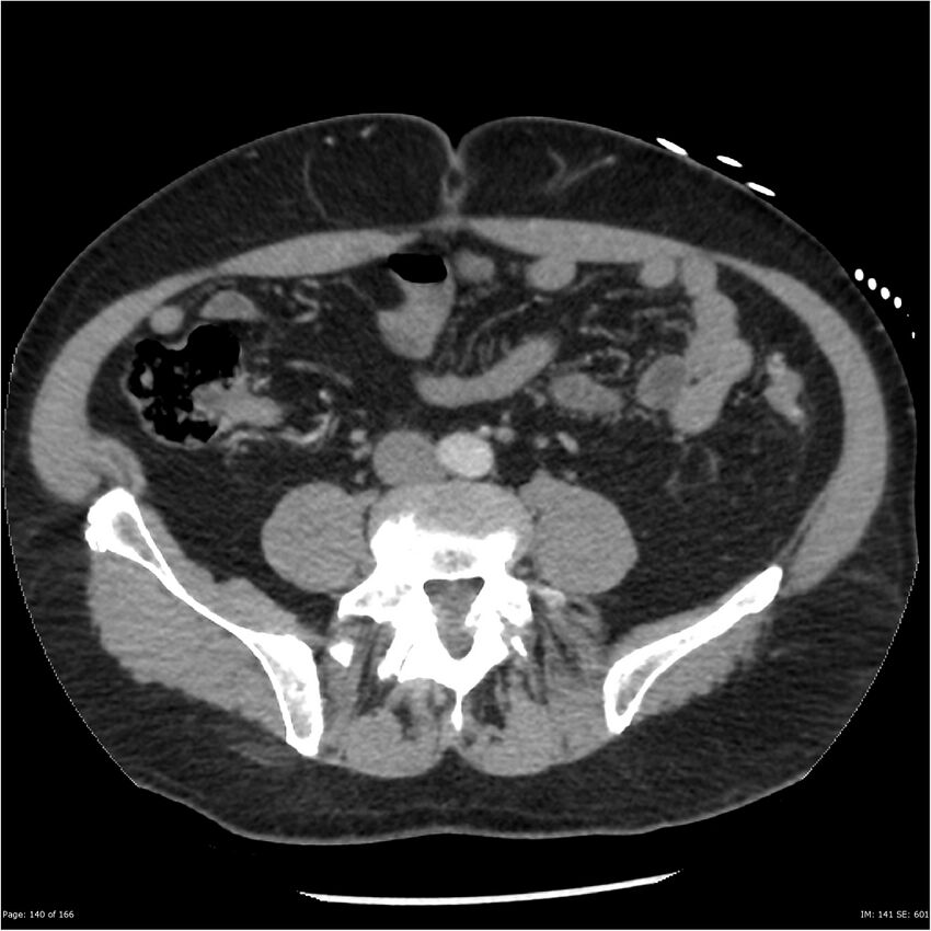 Aortic dissection- Stanford A (Radiopaedia 37759-39664 A 131).jpg
