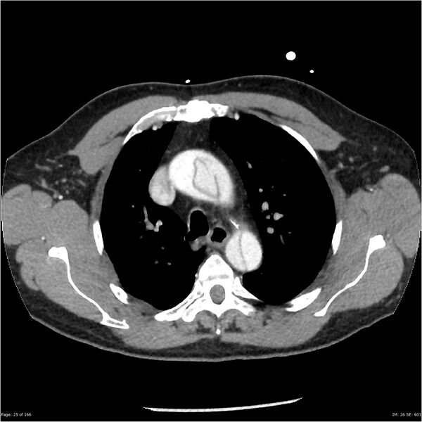 File:Aortic dissection- Stanford A (Radiopaedia 37759-39664 A 16).jpg