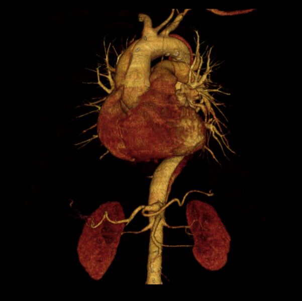 File:Aortic dissection with rupture into pericardium (Radiopaedia 12384-12647 D 36).jpg