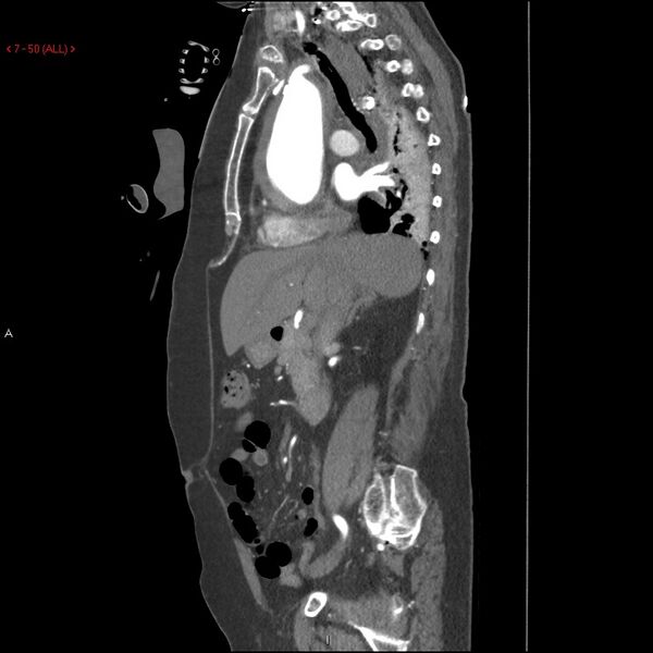 File:Aortic intramural hematoma (Radiopaedia 27746-28001 C 19).jpg