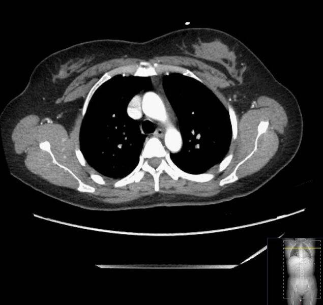 File:Appendicitis (CT angiogram) (Radiopaedia 154713-127660 Axial 217).jpg