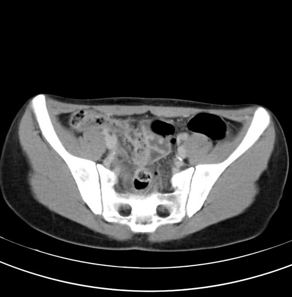 File:Appendicitis and incidental bicornuate uterus (Radiopaedia 22833-22853 Axial C+ delayed 30).jpg