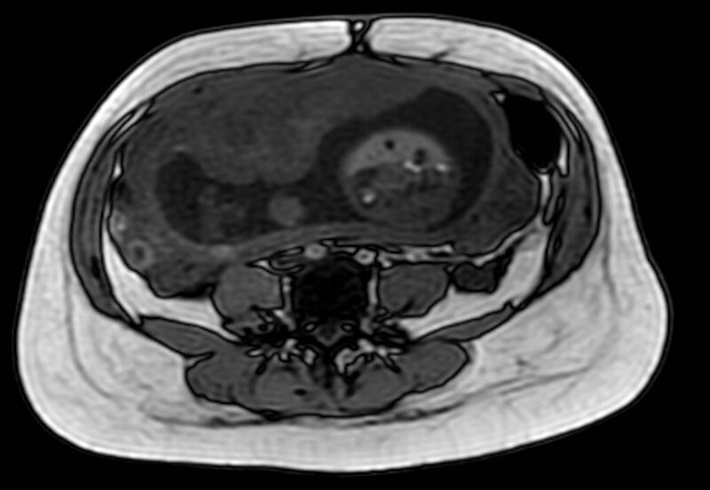 File:Appendicitis in gravida (MRI) (Radiopaedia 89433-106395 D 41).jpg