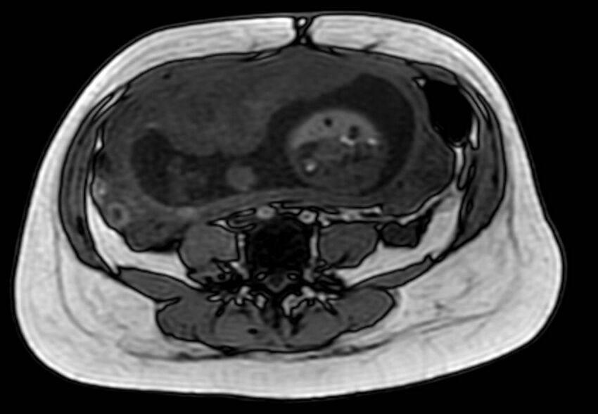 Appendicitis in gravida (MRI) (Radiopaedia 89433-106395 D 41).jpg