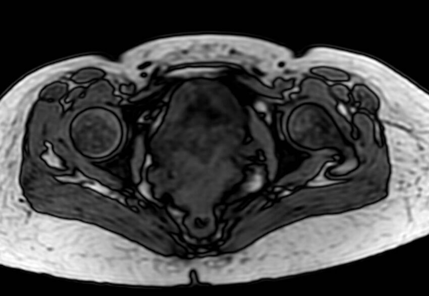 Appendicitis in gravida (MRI) (Radiopaedia 89433-106395 D 67).jpg