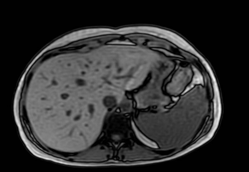 File:Appendicitis in gravida (MRI) (Radiopaedia 89433-106395 D 9).jpg