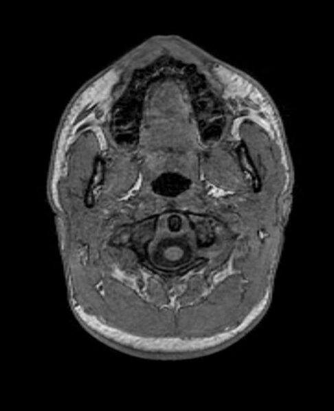 File:Arachnoid cyst- extremely large (Radiopaedia 68741-78451 Axial T1 1).jpg