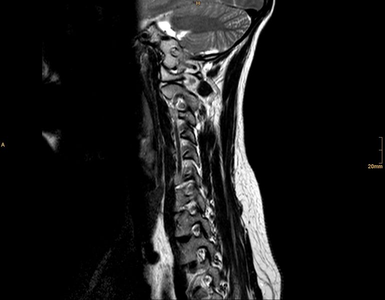 File:Arachnoid cyst - spinal (Radiopaedia 10055-10597 T2 5).jpg