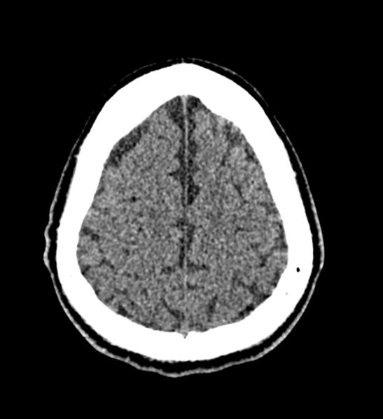 File:Arachnoid cyst of the ambient cistern (Radiopaedia 81301-94986 Axial non-contrast 58).jpg