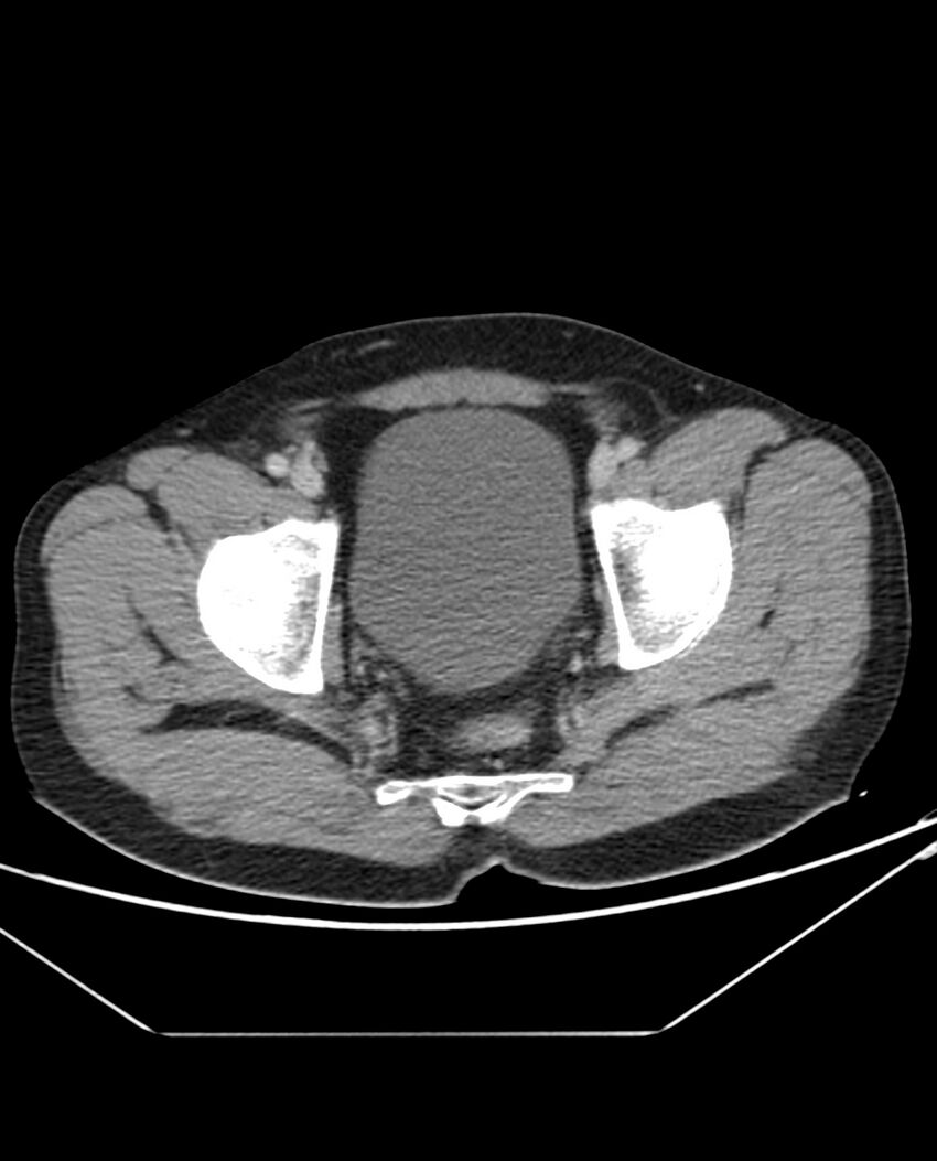Arterial occlusive mesenteric ischemia (Radiopaedia 84641-100054 A 109).jpg