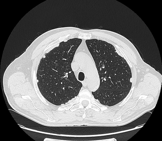 File:Asbestos pleural placques (Radiopaedia 57905-64872 Axial lung window 78).jpg